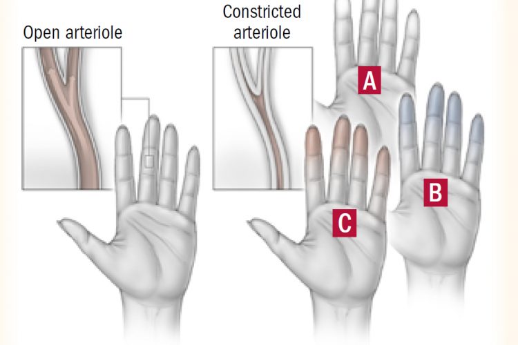 ظاهرة رينو Raynaud’s Phenomenon و دور الأرجينين كعلاج مساعد